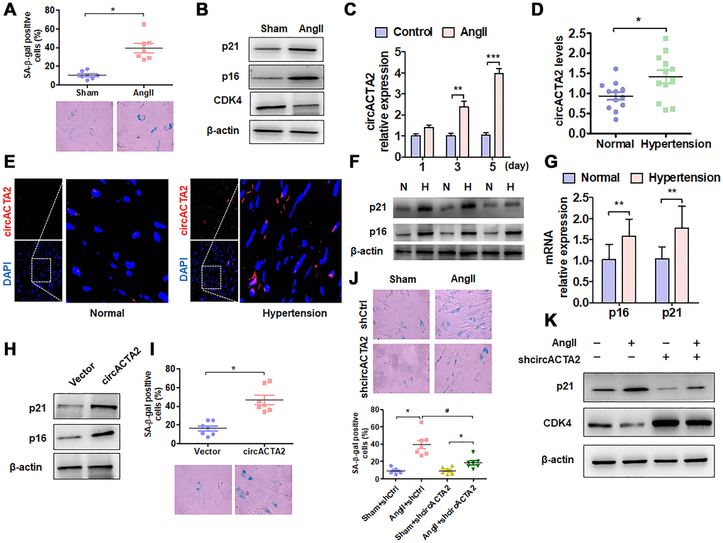 circACTA2 is upregulated in Ang II-induced VSMCs and in the vascular walls of old mice. (A) SA-β-gal activity in VSMCs treated with or without Ang II (100 nmol/L) for 3 days. The percentage of SA-β-gal positive cells (above) and representative pictures (below) are shown. Magnification ×400. *P B) Western blot detection of p21, p16 and CDK4 expression in VSMCs treated with or without Ang II (100 nmol/L) for 3 days. (C) VSMCs were serum-starved for 24 h and then treated with or without Ang II (100 nmol/L) for 1, 3 and 5 days. circACTA2 expression was measured by qRT-PCR analysis. Data represent the means ± SEM of 3 independent experiments. **P ***P D) qRT-PCR detection of circACTA2 expression in the renal artery of hypertensive patients and matched controls. *P E) In situ hybridization of circACTA2 (red) in the renal artery of hypertensive patients and controls. (F) Western blot detected p21 and p16 expression in artery tissues of normal controls (N) and hypertensive patients (H). (G) qRT-PCR detected p21 and p16 mRNA expression in artery tissues of hypertensive patients and normal controls. **P I) SA-β-gal activity in VSMCs transfected with empty vector or circACTA2. The percentage of SA-β-gal positive cells (above) and representative pictures (below) are shown. Magnification × 400. *P J) SA-β-gal activity in VSMCs transfected with shCtrl or shcircACTA2 followed by treatment with or without Ang II. The percentage of SA-β-gal positive cells (left) and representative pictures (right) are shown. Magnification × 400. *P #P K) Western blot detection of p21 and CDK4 expression in VSMCs transfected with shCtrl or shcircACTA2 followed by treatment with or without Ang II.