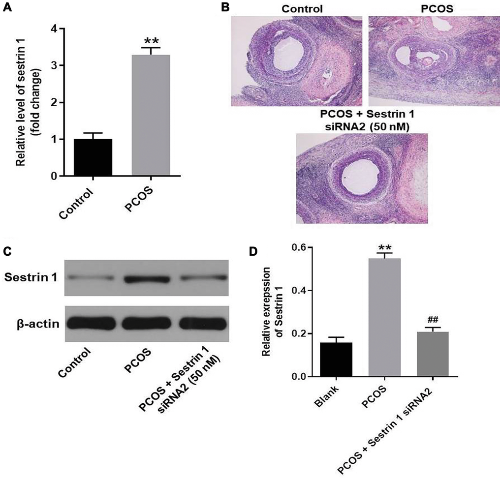 Sestrin 1 overexpression alleviated the progression of PCOS in vivo. (A) Level of sestrin 1 in rat ovarian tissues were detected with RT-qPCR. (B) HE staining of ovarian tissues in each group. (C) The expression of sestrin 1 was detected with western blot. (D) Sestrin 1 expression was quantified. **P ##P 