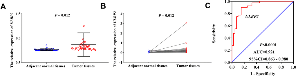 The relative expression and diagnostic ROC curve of ULBP2 gene in COAD tumor tissues and adjacent normal tissues. Notes: (A, B) The relative expression of ULBP2 gene; (C) diagnostic ROC curve. Notes: COAD: colon adenocarcinoma; ULBP: unique long 16 (UL16)-binding protein; AUC: area under the curve; CI: confidence interval.