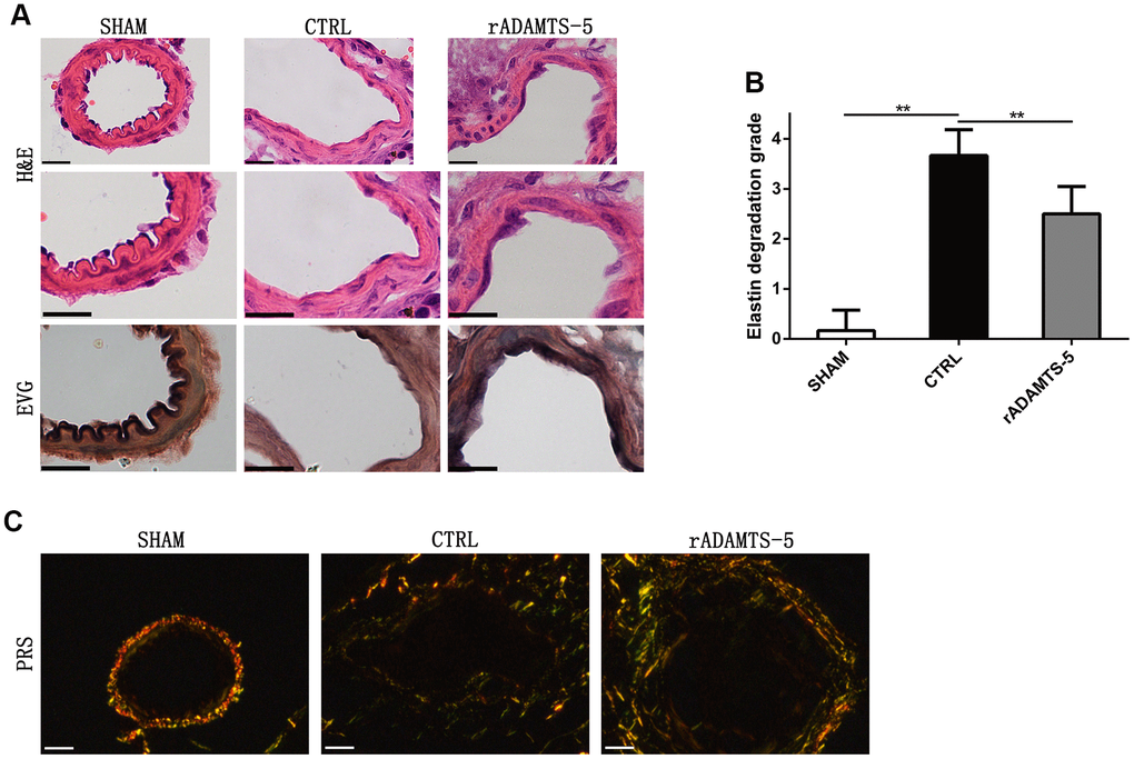 Recombinant protein ADAMTS-5 protected elastase-induced IA mice from vascular matrix degradation. (A) Representative hematoxylin and eosin (H&E) and elastin Verhoeff-Van Gieson (EVG)-stained section of cerebral arterial sections of sham mice, control (CTRL) IA mice, and recombinant protein ADAMTS-5-administered (rADAMTS-5) IA mice. Scale bar: 20 μm. (B) Quantification histogram showing elastin filament degradation. Arterial wall elastin filament degradation was evaluated based on the degree of degradation in elastin fibers (graded 0–4) as described in the Materials and Methods. **PC) Picrosirius red staining for collagen content within the arteries captured by polarization microscopy imaging from the sham mice, control IA mice, and recombinant protein ADAMTS-5-administered (rADAMTS-5) IA mice. Compared with the control group, the rADAMTS-5-administered group showed increased collagen birefringence under polarization. Scale bar: 20 μm.