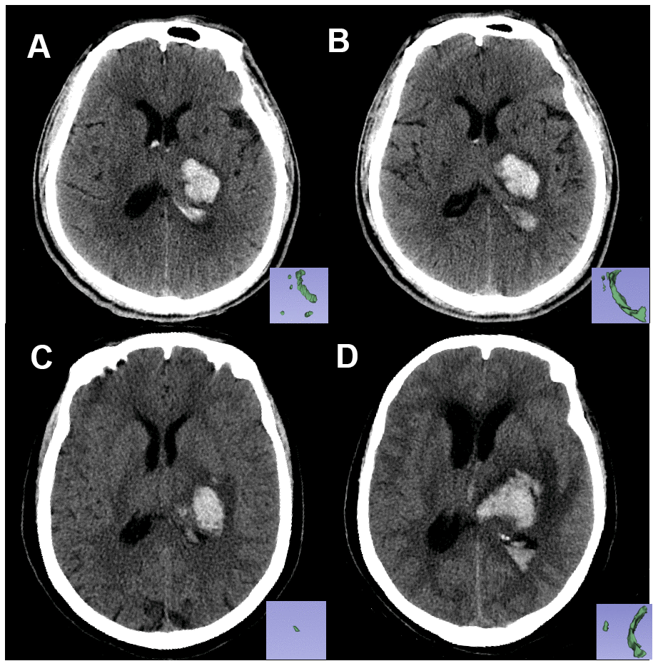 Non-contrast CT images of two patients with similar hematoma but different experiences. Pictures in the lower right corner are the 3-D images of the IVH. Image (A, B) are the baseline and follow-up CT images, respectively, of patient A: a 61-year-old male who had a Rad-score of -2.2119681 (C, D) are the baseline and follow-up CT images, respectively, of patient B: a 67-year-old female with a Rad-score of -1.6176548 (>-1.7259179). Within 24 hours from symptom onset, the IVH volume of patient A changed from 5.62 mL to 6.84 mL, and the IVH volume of patient B changed from 0.5 mL to 12.4 mL. Patient B experienced IVH growth while patient A did not.