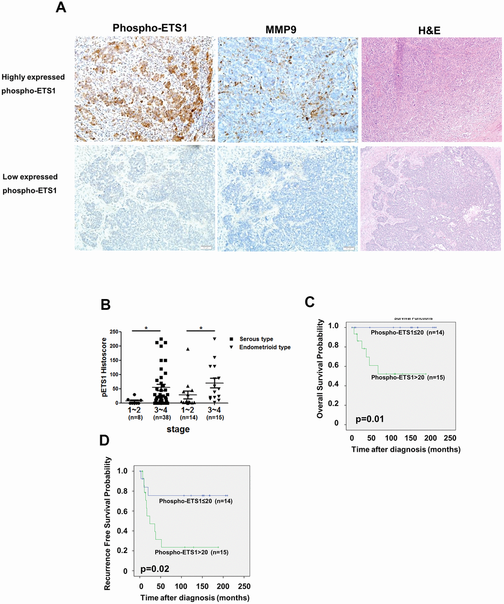 Phospho-ETS1 expression is associated with tumor stage. (A) Immunohistochemical staining of phospho-ETS1 and MMP-9 in ovarian cancer tissues. Tissue with high and low expressed phospho-ETS1 are shown in the upper and lower panels, respectively. (B) Advanced-stage malignancies (stages 3−4) showed a higher immunohistochemical expression of phospho-ETS1 as compared with early-stages tumors (stages 1−2) both in serous (black square) and endometrioid (black triangle) ovarian carcinomas. Asterisks in B denote statistical significance (*p C) and recurrence-free survival (D) in endometrioid type ovarian cancer patients (n = 29) were constructed according to phospho-ETS1 histoscores. The optimal cutoff for phospho-ETS1 histoscore in the prediction of overall survival and recurrence-free survival was 20.