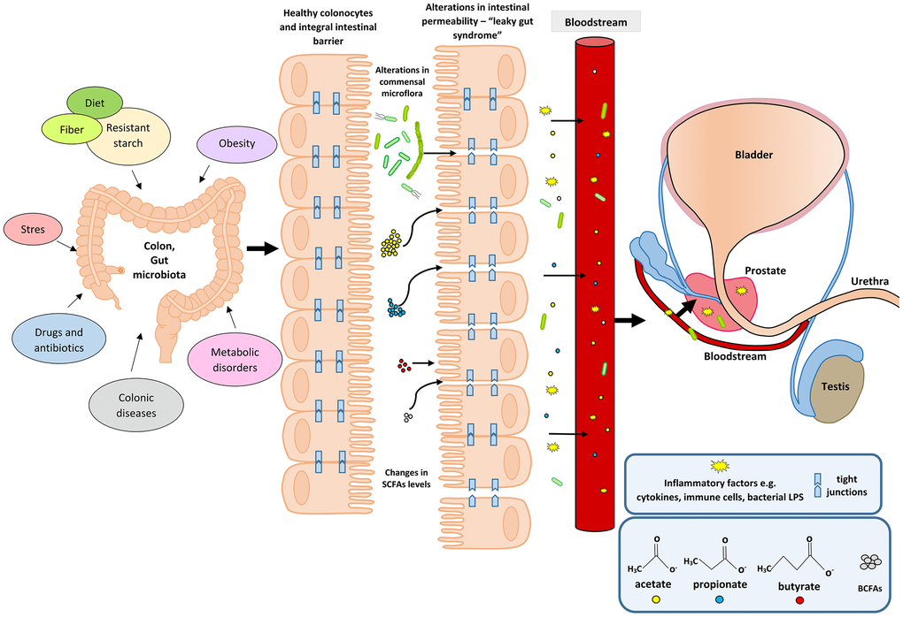 Participation of the intestinal microflora in inflammation and the development of BPH. Disturbances in the intestinal microflora (dysbiosis) can be caused by many factors, among them bad diet that is poor in plant fiber and starch sources. Additionally, the state of intestinal eubiosis may be disturbed by taking antibiotics and other medications, e.g. in the treatment of diabetes or depressive disorders. The specific intestinal microflora—‘obese microbiota’—is found in overweight people and it additionally affects metabolic processes in these people. A different gut microbiome is also observed in people with inflammatory bowel diseases (IBS, IBD). Proper intestinal microflora and its metabolites produced in the fermentation process, including short-chain fatty acids (SCFAs) contribute to the maintenance of intestinal epithelial cell homeostasis, and are a source of energy for colonocytes (mainly butyric acid). Intestinal dysbiosis and changes in SCFAs levels are factors that reduce the protective mucus layer, weaken tight junctions between intestinal epithelial cells, and cause leakage of the intestinal barrier. When the intestinal barrier is disturbed, pathogenic factors, inflammatory factors (immune cells and cytokines) and bacterial metabolites produced in varying amounts, e.g. SCFAs and toxic metabolites enter the bloodstream and migrate to distant tissues and organs. Inflammatory and microbiological factors, along with the peripheral circulation, may also reach the prostate gland, where they cause local inflammation. The inflammatory process in the prostate can activate signaling pathways involving growth factors, thus resulting in the prostate proliferation.