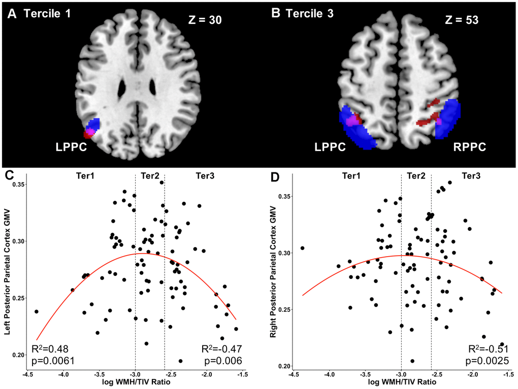 Load-dependent differential relationships between grey matter and white matter hyperintensity load in mild cognitive impairment. (A) The brain slice shows the positive association between voxel-wise GMV and WMH load at Tercile 1 in the left parietal cortex and angular gyrus (red) overlapping with the left posterior parietal cortex ROI (blue). Overlapping region is shown in purple. (B) The brain slice shows the negative association between voxel-wise GMV and WMH load at Tercile 3 in the left and right parietal cortex (red) overlapping with the right posterior parietal cortex ROI (blue). Overlapping regions are shown in purple. Results are shown at the uncorrected pC) In tercile 1, GMV in the left posterior parietal cortex was positively related to WMH load. No relationship was observed at tercile 2. At tercile 3, on the other hand, the inverse was observed, with increasing WMH load relating to lower GMV in the posterior parietal cortex. (D) Similarly, in the right posterior parietal cortex, increasing WMH load in the highest tercile 3 was related to lower GMV. Abbreviations: GMV, grey matter volume; WMH, white matter hyperintensity; Ter, Tercile; L, left; R, right; PPC, posterior parietal cortex; ROI, region of interest.