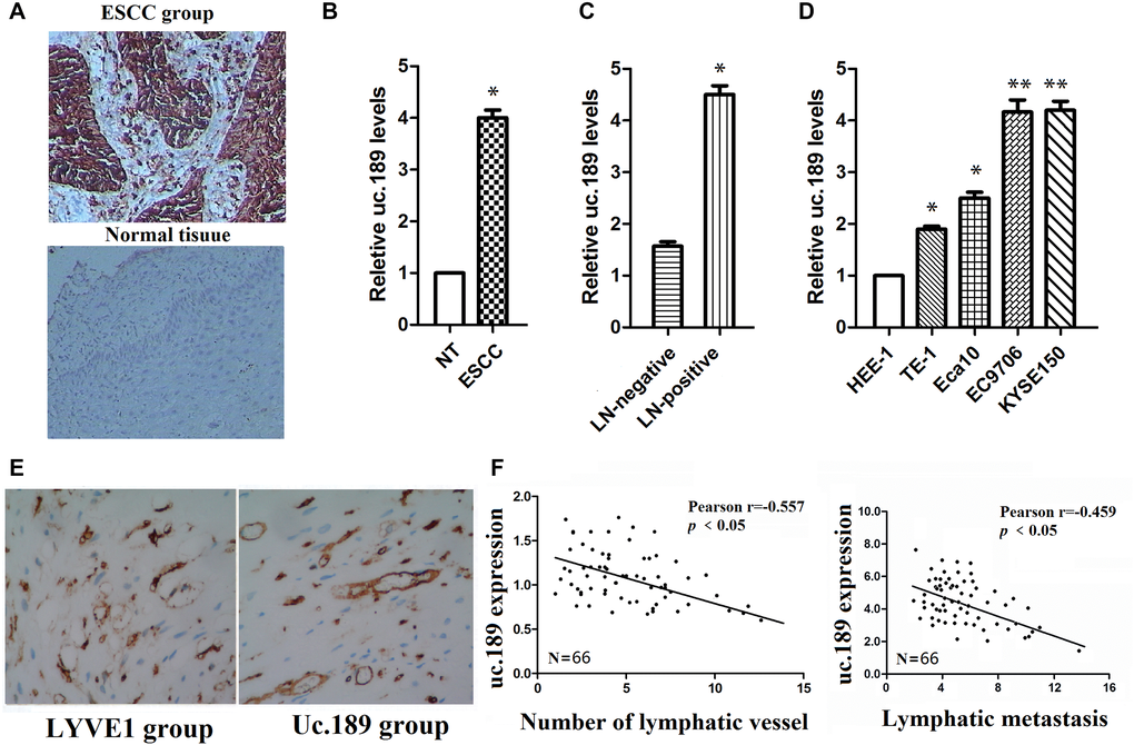 Uc.189 expressions are detected in ESCC tissues and cell lines. (A) uc.189 was a positive expression in ESCC and was a negative expression in normal tissue by ISH. (B) The uc.189 relative expression levels were determined by qRT-PCR in 66 paired human ESCC and normal tissue (NT) samples and normalized against an endogenous U6 RNA control. (C) The relative expression levels of uc.189 in ESCC with lymph-node metastasis (LN-positive; n = 58) and non-metastasis (NM; n = 8). (D) The relative expression levels of uc.189 in the four EC cell lines and normal cells (HEE-1). (E) uc.189 is a positive expression in the peritumoral lymphatic vessel (black arrow) of ESCC specimens and LYVE1 expression as a positive control. (F) Correlation analysis of ISH staining showing a negative correlation between uc.189 expressions and lymphatic vessel density indicated by anti-LYVE-S stain and uc.189 expressions are also a negative correlation with lymphatic metastasis in ESCC (n = 66). *p **p 