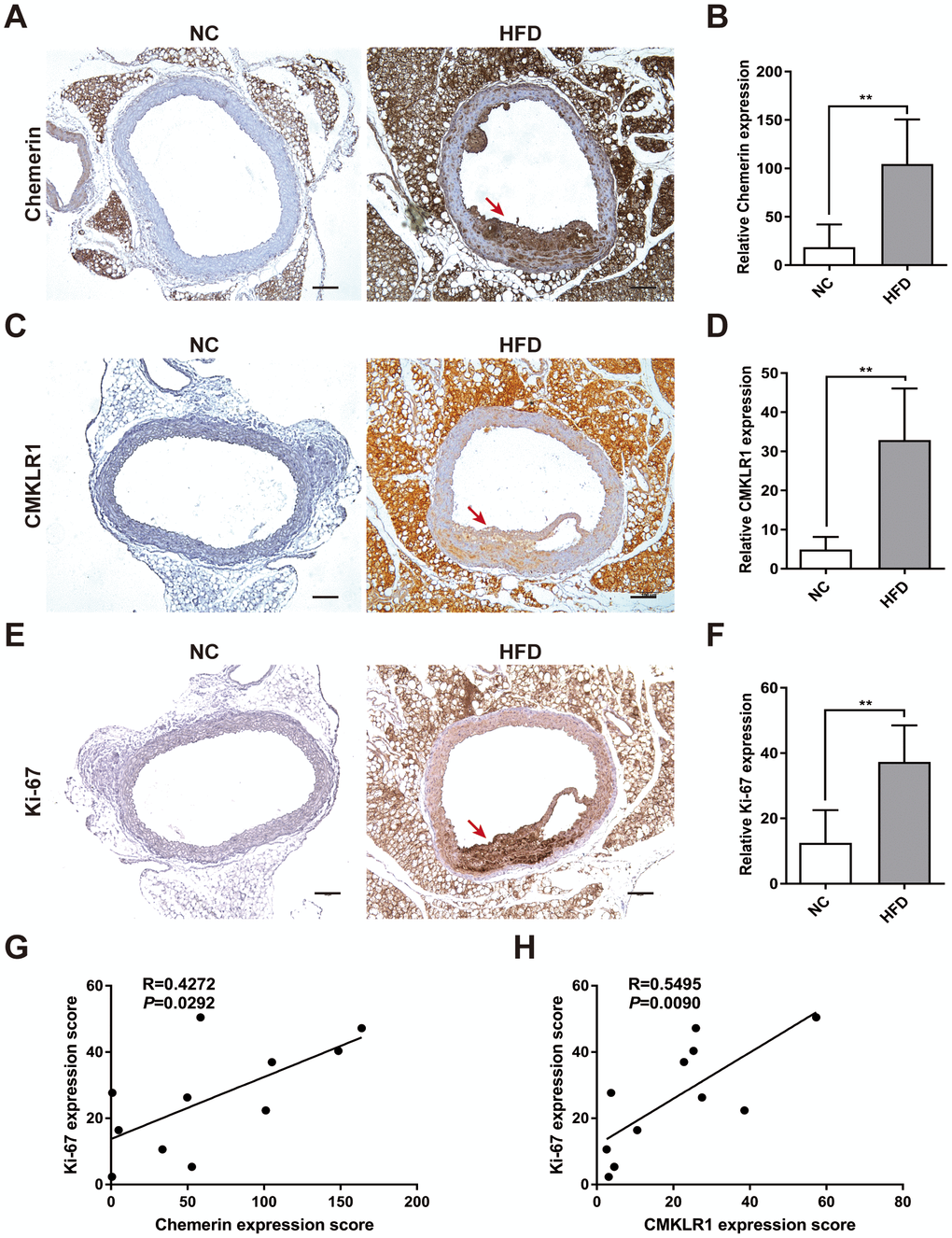 Chemerin / CMKLR1 is overexpressed in the aorta tissues of HFD ApoE-/- mice. A high fat diet (HFD) apo-lipoprotein E−/− (ApoE-/-) mouse model was established to determine the expression of the chemerin / chemokine-like receptor 1 (CMKLR1) axis in atherosclerotic aorta tissues. (A) Immunohistochemical (IHC) analysis of chemerin expression in aorta tissues of negative control (NC, n = 5) and HFD (n = 6) mice. Scale bar = 100 μm. Red arrows indicate plaques. (B) The chemerin expression score analysis data are presented as means ± standard deviations (SDs). **, pC) Representative images of CMKLR1 expression in aorta tissues following IHC analysis. Scale bar = 100 μm. Red arrows indicate plaques. (D) CMKLR1 expression score analysis. **, pE, F) IHC analysis of Ki-67 expression in the aorta tissues of normal and HFD mice. Scale bar = 100 μm. Red arrows indicate plaques. Data from Ki-67 expression score analysis are presented as means ± SDs. **, pG, H) The correlations of chemerin / CMKLR1 and Ki-67 were calculated using the Spearman method.