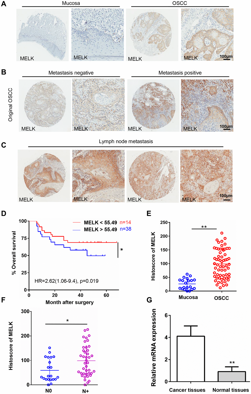 High MELK expression in OSCC tissues correlates closely with lymph node condition. (A) Representative images of MELK expression assessed via IHC staining normal oral mucosa (left) and OSCC (right). Scale bars = 100 μm. (B) Typical images of MELK expression assessed via IHC staining in metastasis-negative (left) and metastasis-negative OSCC (right). Scale bars = 100 μm. (C) Representative photographs of MELK in lymph node metastasis. Scale bars = 100 μm. (D) Kaplan–Meier analysis of OSCC patients with MELK expression level. (E) Score of MELK in oral mucosa (n = 20) and OSCC (n = 62). (F) Score of MELK in OSCC with or without lymph node metastasis. (G) The relative MELK mRNA level in patients with OSCC paired cancer and normal tissues. *P **P ***P 