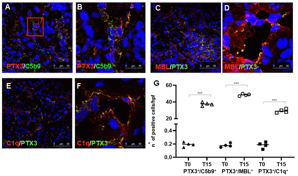 PTX3-mediated Complement activation in a pig model of I/R injury. Frozen pig kidney sections were examined by indirect immunofluorescence to investigate the co-localization (yellow staining) of C5b9 (green) and PTX3 (red) deposits (A, B). The co-localization between PTX3 (green) with MBL (red, C, D) and C1q (E, F) was investigated by immunofluorescence/confocal microscopy. PTX3 co-localized with MBL (C, D, yellow staining) and C1q (E, F, merge) at peri-glomerular (E) and peri-tubular (D, F) capillary sites. In confocal microscopy images nuclei were stained with TO-PRO 3 (blue). (G) Quantification of C5b9+/PTX3+, MBL+/PTX3+and C1q+/PTX3+cells compared to basal biopsies. Results were expressed as % ± s.d. of positive area /high power field (hpf). *p