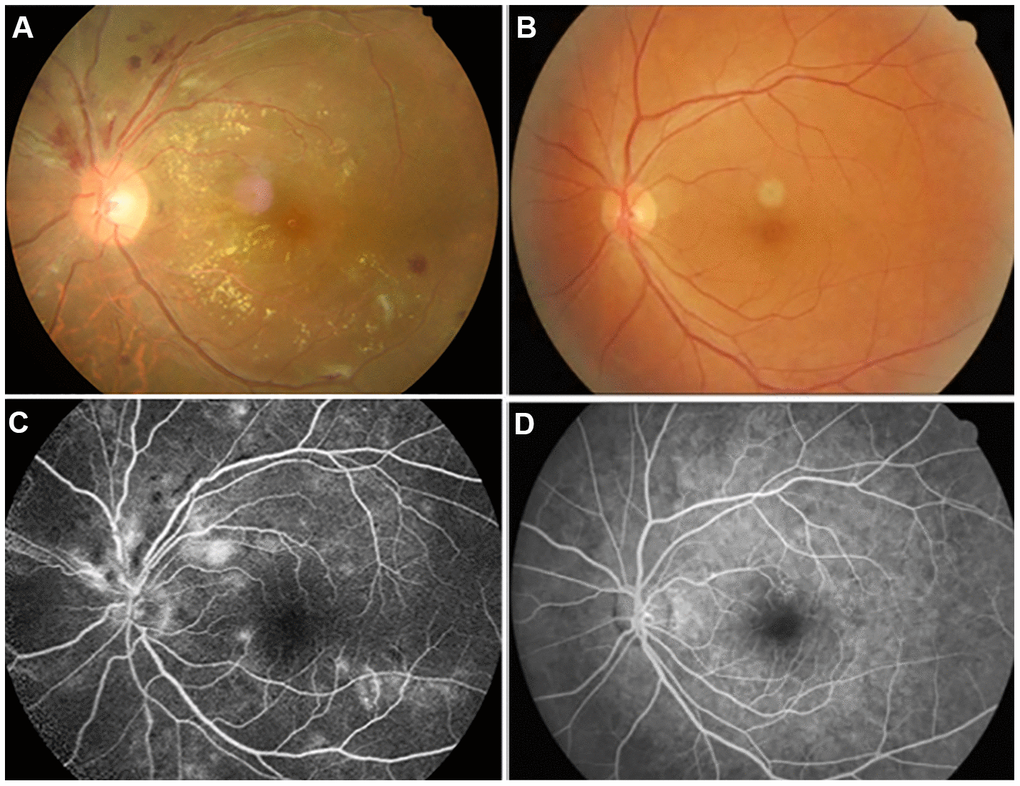 Examples of retinal fundus photography (above) and fluorescence fundus angiography (below) in the HR patients and HC group. Notes: (A) shows the left retinal fundus photos of patients with hypertensive retinopathy and (B) shows the left retinal fundus photos of normal people. (C) shows left fluorescence fundus angiography in patients with hypertensive retinopathy, and (D) shows corresponding fluorescence fundus angiography in normal subjects. (A, C) Correspond to the same person, and (B, D) correspond to another person.