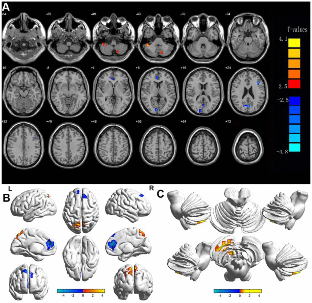 Display of DC values in different brain regions. Notes: Significant differences in DC were observed in (A, B) shows the changes in DC in the cerebral cortex, and (C) shows the changes in DC in the cerebellum. The yellow regions indicate higher DC values.