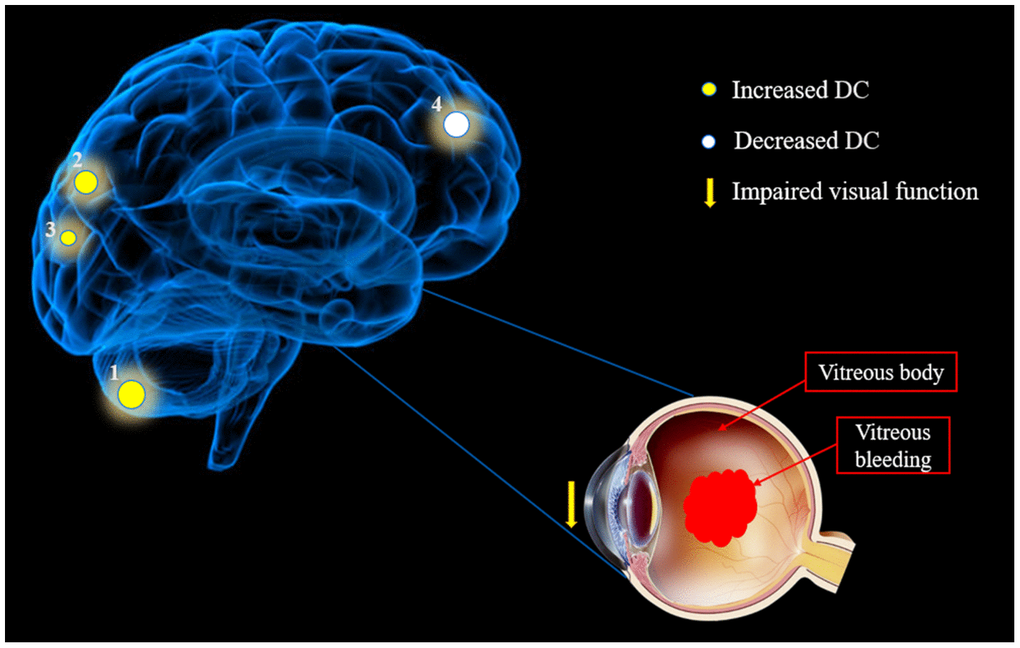 The mean DC values of altered brain regions in the hypertensive retinopathy group. Notes: Compared with the HCs, the DC values of the following regions were increased to various extents: 1- Cerebellum Posterior Lobe. L (-, t=4.4835), 2- Medial Occipital Gyrus. L (BA19, t=4.3309) and 3- Precuneus. B (-, t=3.9827), whereas the DC value of the following region was decreased: 4- Medial Frontal Gyrus/B Anterior Cingulate. R (-, t = -4.2564). The sizes of the spots denote the degree of quantitative changes. Abbreviations: DC, degree centrality; HCs, healthy controls; L, left; R, right; B, Bilateral; BA, Brodmann's area.