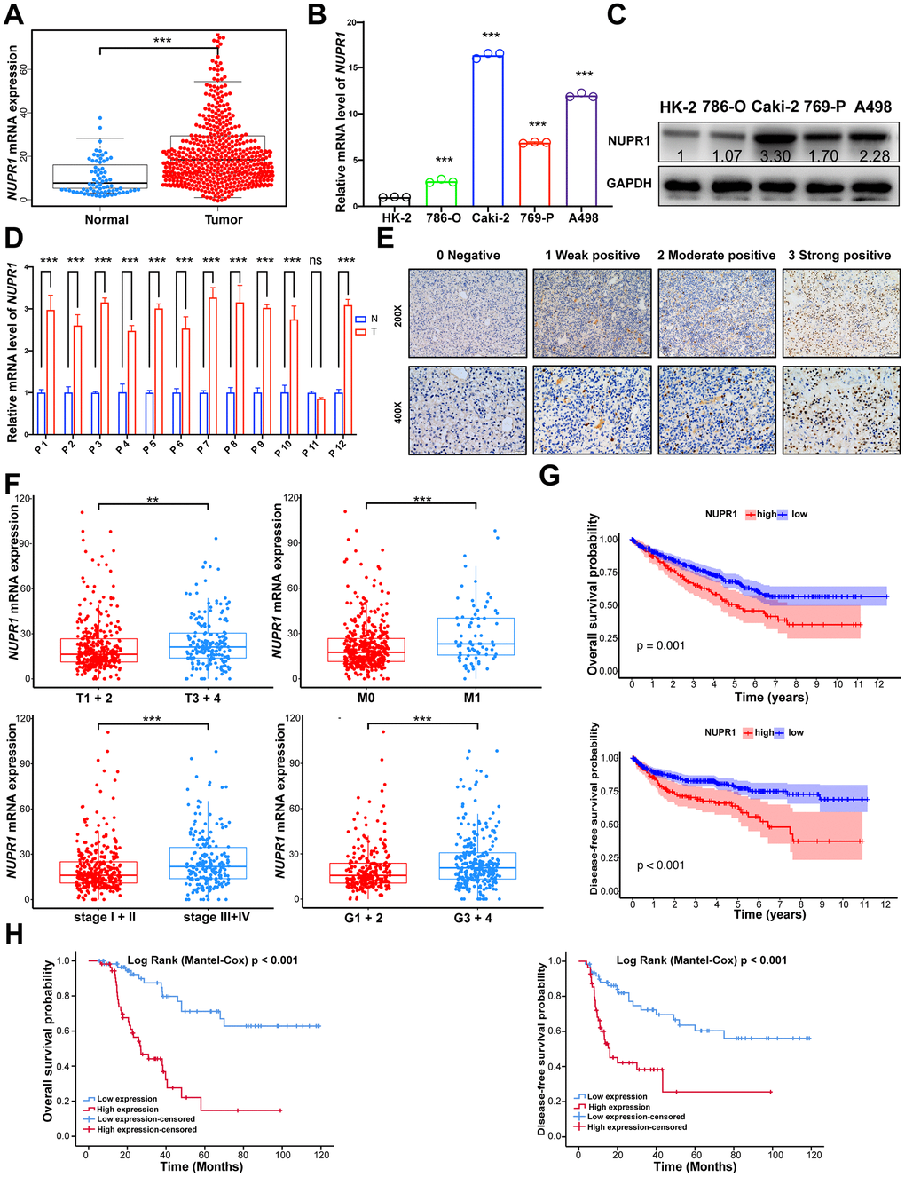 NUPR1 upregulated is predominantly found in ccRCC and associated with poor prognosis. (A) Comparison of NUPR1 mRNA expression between ccRCC and normal kidney tissue from TCGA-KIRC dataset. (B) Relative mRNA level of NUPR1 in ccRCC cell lines compared with human renal proximal tubular epithelial cell line HK-2. (C) Western blot showed NUPR1 protein expression in ccRCC cell lines and HK-2. (D) Relative mRNA level of NUPR1 in twelve ccRCC tissues and paired normal kidney tissues. (E) Immunostaining of NUPR1 expression in 117 ccRCC tissues. Immunostaining intensity was scored as 0 negative, 1 weak positive, 2 moderate positive and 3 strong positive. (F) Overexpression of NUPR1 was associated with higher pathologic T stage, metastasis, elevated clinical stage and histologic grade in TCGA-KIRC dataset. (G) Kaplan-Meier curves of overall survival and disease-free survival time between low (n=135) and high (n=389) NUPR1 mRNA level groups in TCGA-KIRC dataset. The cutoff value was the mean of NUPR1 mRNA level in 524 ccRCC tissues. (H) Kaplan-Meier curves of overall survival and disease-free survival time between low (n=59) and high (n=58) NUPR1 immunostaining intensity groups in cohorts from Shandong Provincial Hospital. The median IHC score was used as the cutoff value. (*p p p 