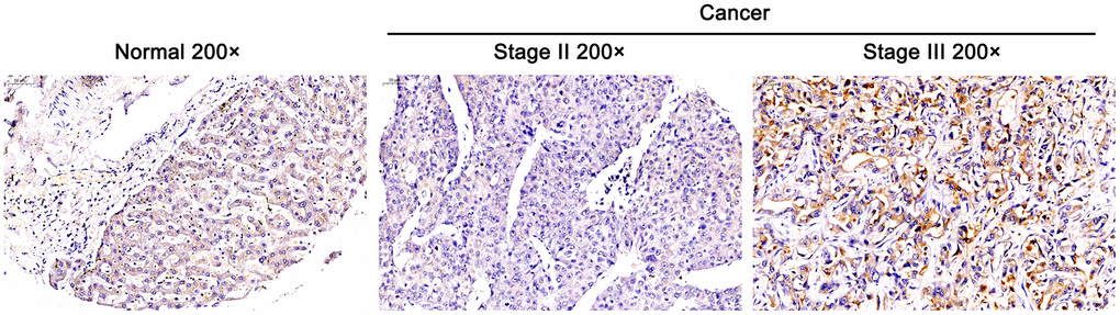 Overexpressed DEPDC1B in tumor tissues and it was related to advanced stage. The expression of DEPDC1B was detected by immunohistochemistry and overexpressed in cancer tissues compared with normal tissues (Magnification ×200, scale bar = 50 μm).