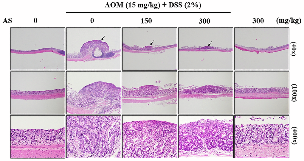 Histopathological examination of the colon from the AOM/DSS- and/or AS-treated ICR mice. Representative portion of colon tissues was stained by hematoxylin and eosin, and observed under 40×, 100×, and 400× magnification.