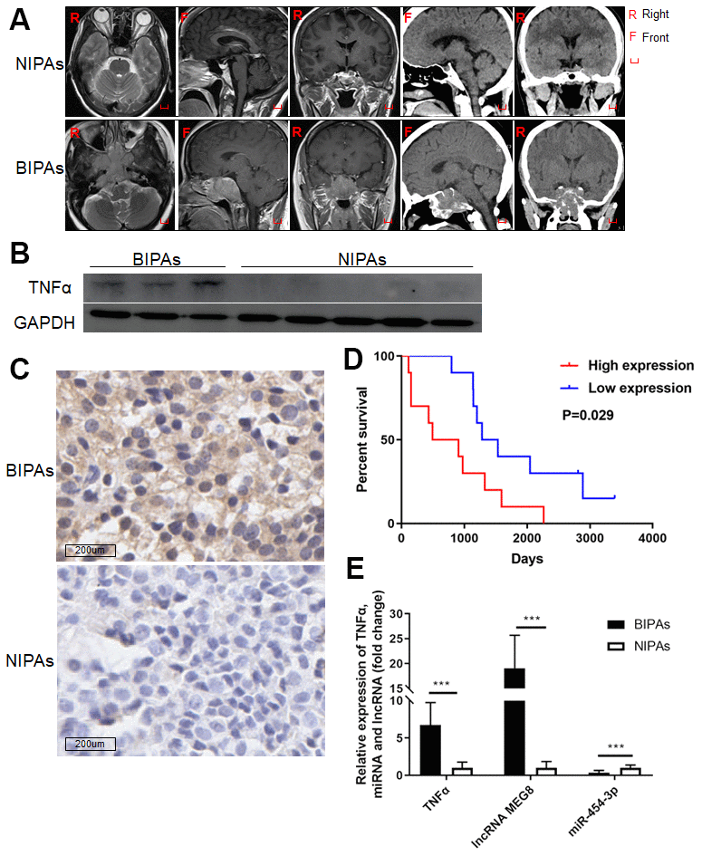 The expression of TNF-α, MEG8 and miR-454-3p in PAs and the relationship between the expression of TNF-α and the prognosis of patients. (A) The preoperative images of NIPAs and BIPAs. Western blot (B) and IHC (C) were used to detect the expression of TNF-α in BIPAs and NIPAs. (D) Kaplan-Meier plotter was used to analyze the regrowth-free curves of patients in TNF-α high/low groups. (E) RT-qPCR was used to detect the expression of TNF-α, MEG8 and miR-454-3p in BIPAs and NIPAs. ***P 