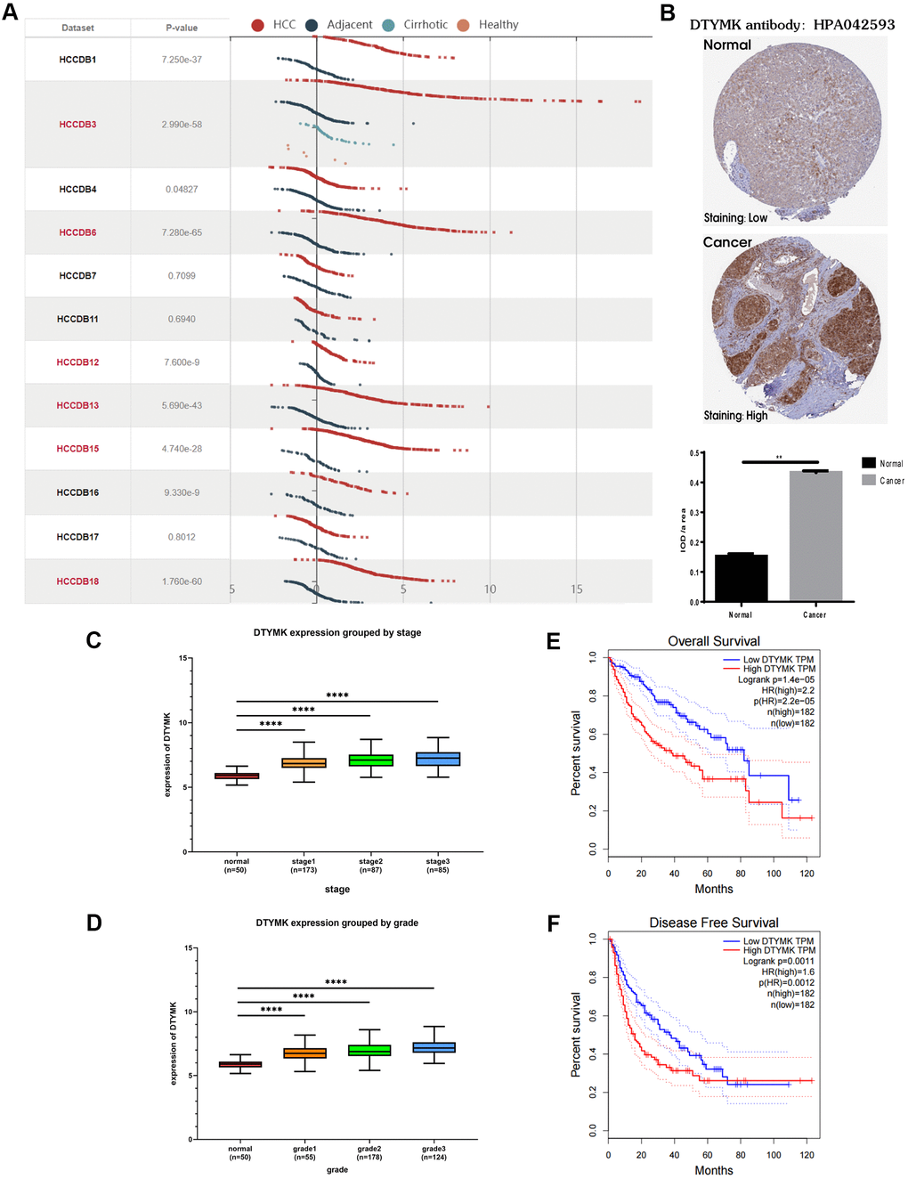 Bioinformatics analysis of DTYMK in HCC. (A) Gene expression profiles of DTYMK in the HCCDB database. (B) Representative immunohistochemistry (IHC) images from the HPA with the DTYMK antibody. (C) The expression level of DTYMK was positively correlated with tumor stage in HCC patients. (D) The expression level of DTYMK was positively correlated with tumor grade in HCC patients. (E) Overall survival analysis of DTYMK in GEPIA. (F) Disease free survival analysis of DTYMK in GEPIA. *** represents p 