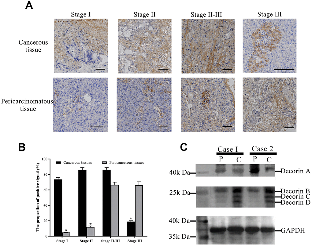 Decorin expression profile in PC patients. (A) Immunohistochemical analysis of decorin during the pathological stages of PC, bar indicates 100 μm; (B) The quantification of decorin during the pathological stages of PC based on the results of immunohistochemical analysis. (C) Western blot of decorin in cancerous and para-cancerous tissue of PC patients, C: cancerous tissues, P: paracancerous tissues.