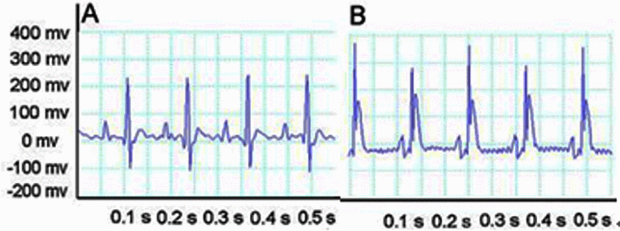 ECG shows typical dynamic changes. (A) ECG before ligating the coronary artery. (B) After ligation, the ST of ECG is elevated.
