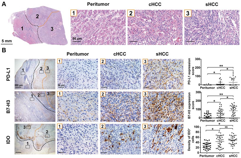 Typical pathology of sHCC and PD-L1, B7-H3 and IDO expression in the sHCC. (A) Hematoxylin and eosin staining in a sHCC sample. (B) Specimens were stained with PD-L1, B7-H3, and IDO, respectively, and the expression in sarcomatoid components, conventional HCC components, and peritumor components are shown. Graph: expression of PD-L1 and B7-H3, as well as IDO+ cell densities (cells/mm2) of each region are indicated in dot plot. *p