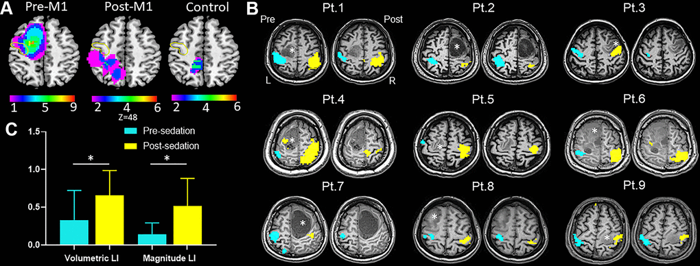 Results of task-fMRI in M1 group. (A) Probability maps of lesion distribution for M1, post-M1 and control groups. The yellow circle denoted location of anterior central gyrus. (B) Hand motor task-fMRI results of nine patients from M1 group. Axial individual anatomical images with superimposed functional activation pre- and post-administration of dexmedetomidine were presented. In the lesional hemisphere, activation of the hand task decreased significantly after sedation. Right (R) and left (L) hemispheres are marked. *indicates locations of the lesions. (C) The bar graph showed both magnitude lateralization index (LI-M) and volumetric LI (LI-V) of M1 increased significantly after sedation in M1 group (mean with 95% CI) (*P 