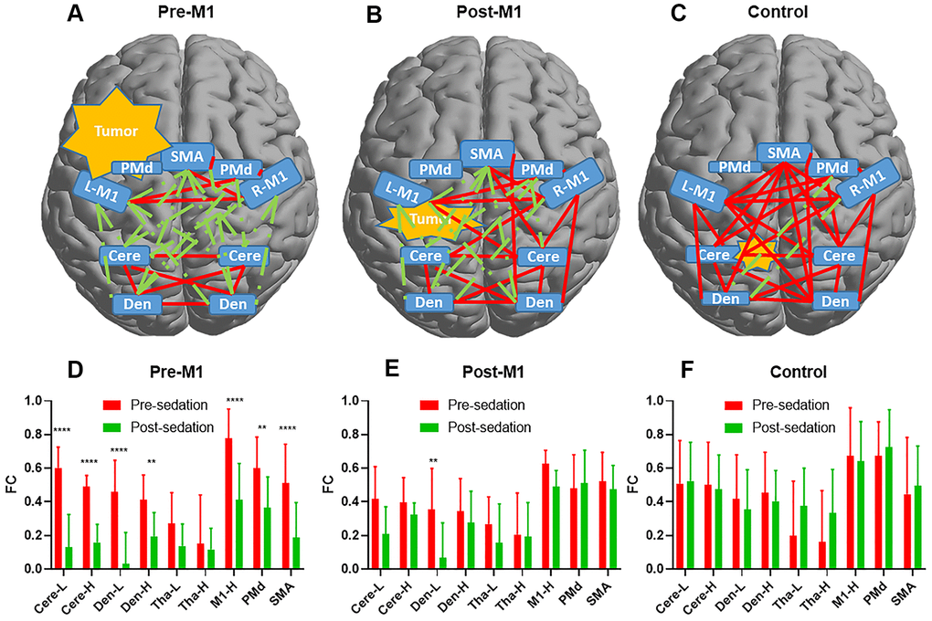 The functional connectivity (FC) alteration before and after sedation. Delineation of FCs after sedation for pre-M1 (A) post-M1 (B) and control (C) groups. Red line denoted FC ≥ 0.3 while green line denoted FC D–F) Changes of FCs between M1-L and the other 9 nodes pre- and post-sedation in each group. 7 of 9, 1of 9 and 0 of 9 FCs decreased significantly (p[FDR] D) post-M1 (E) and control (F) group respectively (** P P 