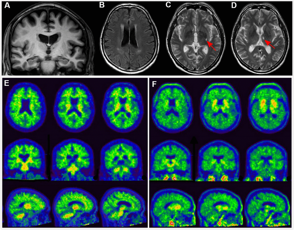 Clinical utility of AD-RAI in MCI subjects. A 68-year-old man with 11 years of education had complaints of memory decline for over 3 years. Z-score in Trial 4 of HKLLT was -1.94 SD (≤ -1 SD, i.e. MCI). Visual MTA rating score on MRI was 1 (≥ 1), (A) which was suggestive of AD. However, HV measures yielded conflicting results, with HF of 0.47% (> 0.41%) and raw HV of 7.38ml (> 6.07mL) suggestive of non-AD. FLAIR and T2-weighted sequences showed periventricular white matter hyperintensity and two subcortical lacunes (red arrows) (B–D). AD-RAI was only 0.11 (E) and T807 PET (F) showed negative results (i.e. A-T-), supporting the finding of AD-RAI. The MCI syndrome and mild MTA might be associated with cerebral SVD (i.e. vascular MCI associated with SVD).