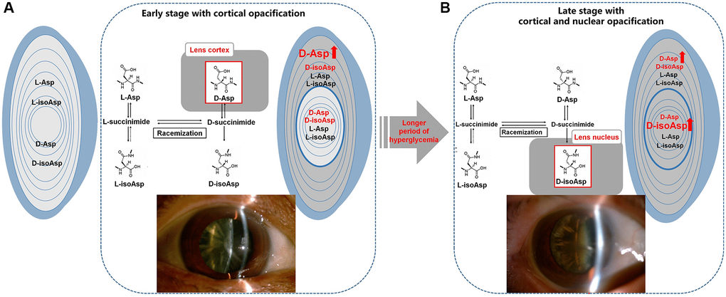 Illustration of the normal L-Asp 58 spontaneously converted to L-isoAsp 58, D-Asp 58, and D-isoAsp 58 in diabetic lenses. (A) The main difference in racemization at Asp residues in the lenses of DC patients was an increased percentage of D-Asp 58 in the cortex, leading to the early stage of cortical opacification in DC. (B) Over the protracted duration of diabetes, the percentage of D-isoAsp 58 in the nucleus increased, leading to the further nuclear opacification on the original basis of cortical opacification in the late stage of DC. L-Asp = L-Asp 58, L-isoAsp = L-isoAsp 58, D-Asp = D-Asp 58, D-isoAsp = D-isoAsp 58.