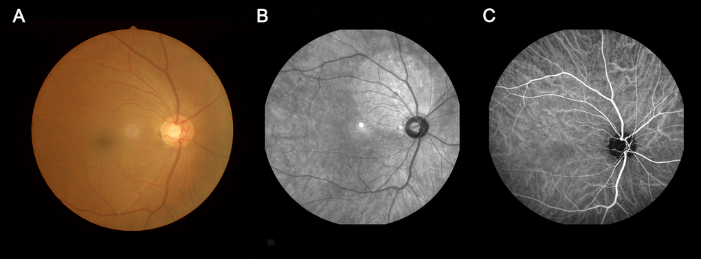 An example of MCI. (A) fundus photography; (B) fundus fluorescein angiography; (C) indocyanine green angiography. Abbreviations: MCI, mild cognitive impairment.