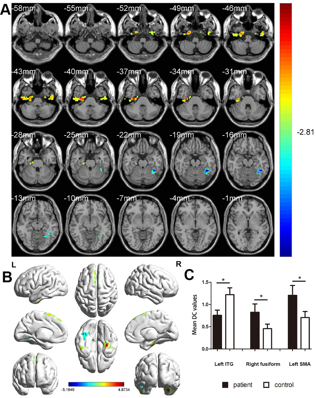 Comparison of DC values in MCI and HC groups. (A) Differences in DC were found in left ITG, right fusiform gyrus, and left SMA. (B) The stereoscopic form of the cerebrum. The red area indicates an increase in DC value; the blue indicates a decrease in DC value. (GRF correction, the cluster-level: PC) The Mean DC value between MCIs and control group. Abbreviations: DC, Degree centrality; MCI, mild cognitive impairment; HC, healthy controls; ITG, inferior temporal gyrus; SMA, supplementary motor area.