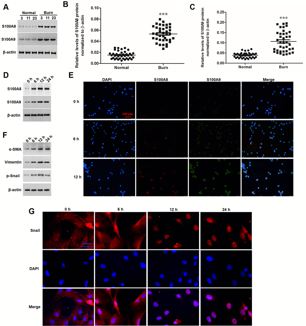 S100A8 and S100A9 were upregulated in post burn skin and thermal-stimulated keratinocytes. (A) Representative blots for S100A8 and S100A9 in burned and matched normal skin tissues from burn patients. Comparison of (B) S100A8 and (C) S100A9 in burned and matched normal skin tissues of 38 patients. (D) Expression of S100A8 and S100A9 and (F) EMT marker proteins in thermal-stimulated keratinocytes was detected with Western blotting at different time points. (E) Double immunofluorescence assay for cellular localization of S100A8 and S100A9 and (G) immunofluorescence assay for nuclear translocation of Snail protein in thermal-stimulated keratinocytes at different time points. ***P 