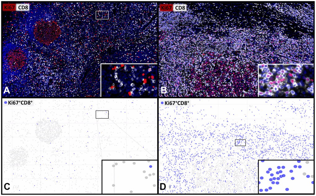 Representative images and visualisations showing the cell detection of proliferating CD8+ T-lymphocytes. Multiplex immunofluorescence images (A, B) showing CD8+ cytotoxic T-lymphocytes (white) and Ki67+ proliferating cells (red) with a low (A, C) and a high (B, D) percentage of proliferating Ki67+CD8+ T-cells. The visualization (C, D) of the digital image analysis underlines the accuracy of the automated detection of the subset of Ki67+CD8+ proliferating cytotoxic T-cells (blue). 400x magnifications are shown in the insets.