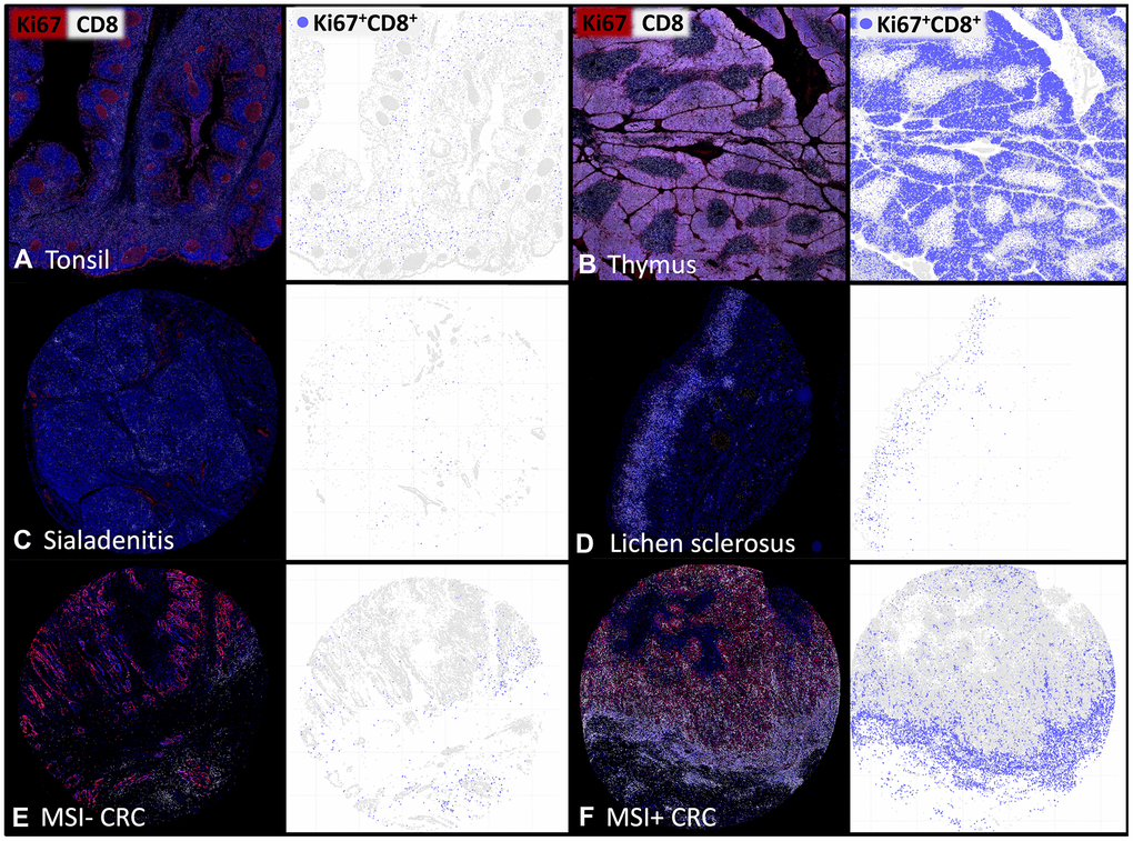 The density of proliferating CD8+ T-lymphocytes varies between tissues and individual patients. Representative multiplex immunofluorescence images of CD8+ (white) and Ki67+ (red) cells in (A) normal human tonsil, (B) thymus, (C) sialadenitis, (D) lichen sclerosus, (E) Microsatellite stable colorectal cancer (MSI- CRC) and (F) Microsatellite instable colorectal cancer (MSI+ CRC). The visualizations of the digital image analysis highlight the subset of Ki67+CD8+ proliferating cytotoxic T-cells (blue).