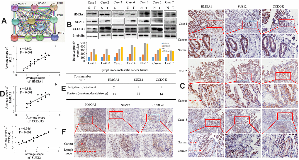 Protein expression level of HMGA1, SUZ12 and CCDC43 in human GC patients. (A) SUZ12-related protein-protein interaction (PPI) network from the STRING database. (B) Expression of HMGA1, SUZ12 and CCDC43 protein in each of the primary GC (T) and adjacent noncancerous tissues (N) paired from the same patient by western blotting. The protein expression levels were quantified by comparing the gray level of each band using Quantity One Software (below). (C) Immunohistochemical staining of HMGA1, SUZ12 and CCDC43 in gastric tissues. (D) The correlation between SUZ12 and HMGA1, between CCDC43 and HMGA1, or between SUZ12 and CCDC43 in GC tissues. (E, F) Immunohistochemical analysis of three protein expression in metastatic lymph nodes. Scale bars, 50 μm in (C, F).