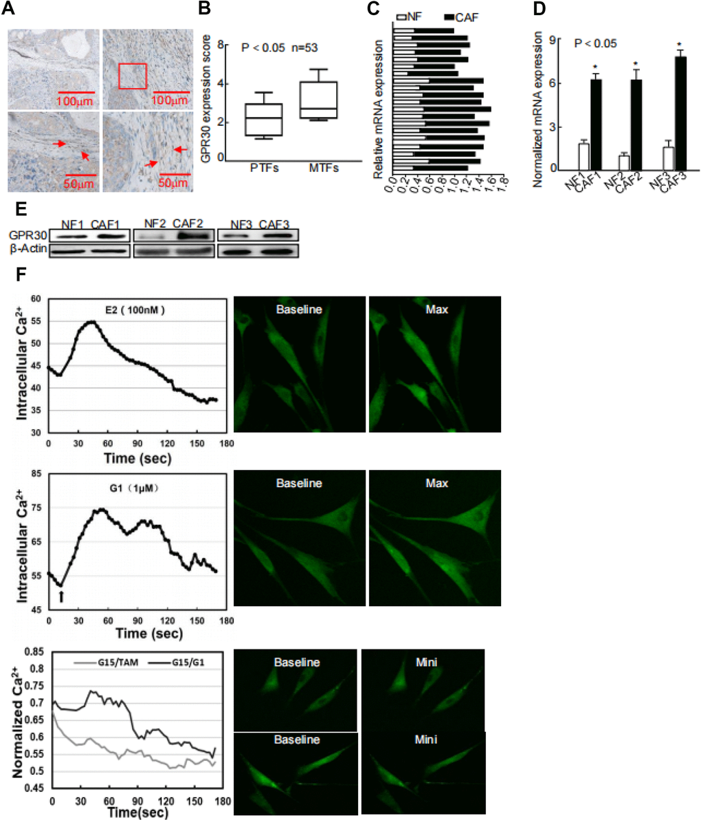 Abnormally activated and increased GPR30 in TAM-resistant breast CAFs. (A) Representative cases of immunostaining of breast tumor tissue samples, (B) Quantitative GPR30 staining in primary tumor fibroblasts (PTFs) and metastatic fibroblasts (MTFs). (C) Breast cancer tissues and (D) paired immortalized cells evaluated by real time quantitative-PCR. GPR30 was detected in NFs and CAFs; each sample was normalized to its β-actin mRNA content. (*P t-test). (E) GPR30 protein content in paired cell lines. (F) GPR30 is activated by TAM and G1 in breast CAFs. Treatment with TAM (10 nM) and G1 (1 μM) for 15 min, with or without pretreatment with G15 (1 μM) in CAFs, and monitoring of Ca2+ labeled with the Fluo-3/AM probe by laser scanning spectral confocal microscopy. Scale bar: 25 mm (*P 