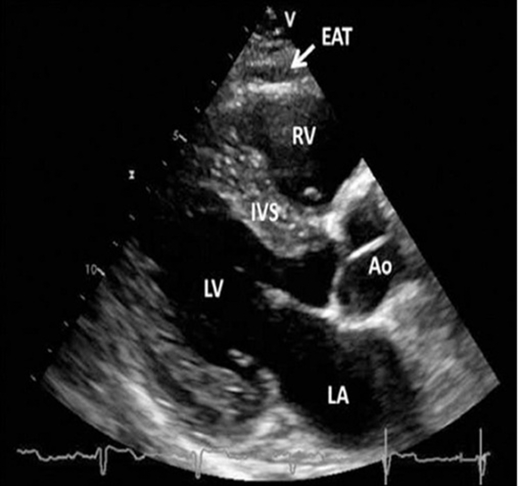 Transthoracic echocardiographic view of epicardial adipose tissue. Epicardial adipose tissue is an echo-lucent area between the epicardial surface and parietal pericardium in front of the right ventricular free wall and is indicated with a white arrow. Abbreviations: Ao, aorta; EAT, epicardial adipose tissue; IVS, interventricular septum; LA, left atrium; LV, left ventricle; RV, right ventricle [36, 37].