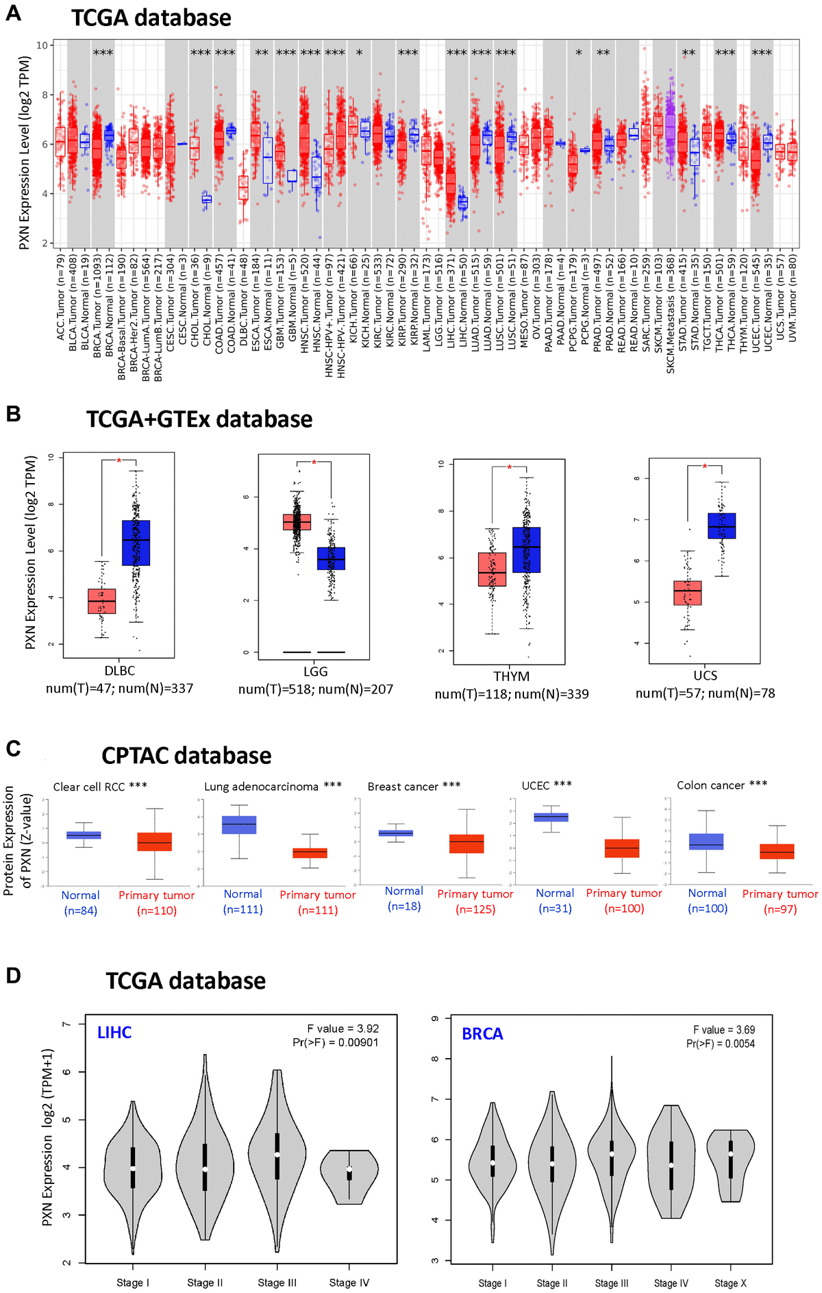 PXN gene expression in different tumors and pathological stages (A) using TIMER2 to analyze the expression of PXN in different cancers or specific cancer subtypes (*P **P ***P B) using the box plot data to analyze the type of lymphoid neoplasm DLBC, LGG, thymoma, and uterine carcinosarcoma in TCGA, for which the corresponding normal tissues of the GTEx database were included as controls (**P C) Using the CPTAC dataset, PXN total protein expression levels in normal tissue versus primary tissue were analyzed for RCC, lung adenocarcinoma, breast cancer, UCEC, and colon cancer (***P D) Using TCGA data, PXN gene expression was analyzed by main pathological stage (stage I, stage II, stage III, and stage IV) of LIHC and BRCA. Log2 (TPM + 1) was used for the log scale.