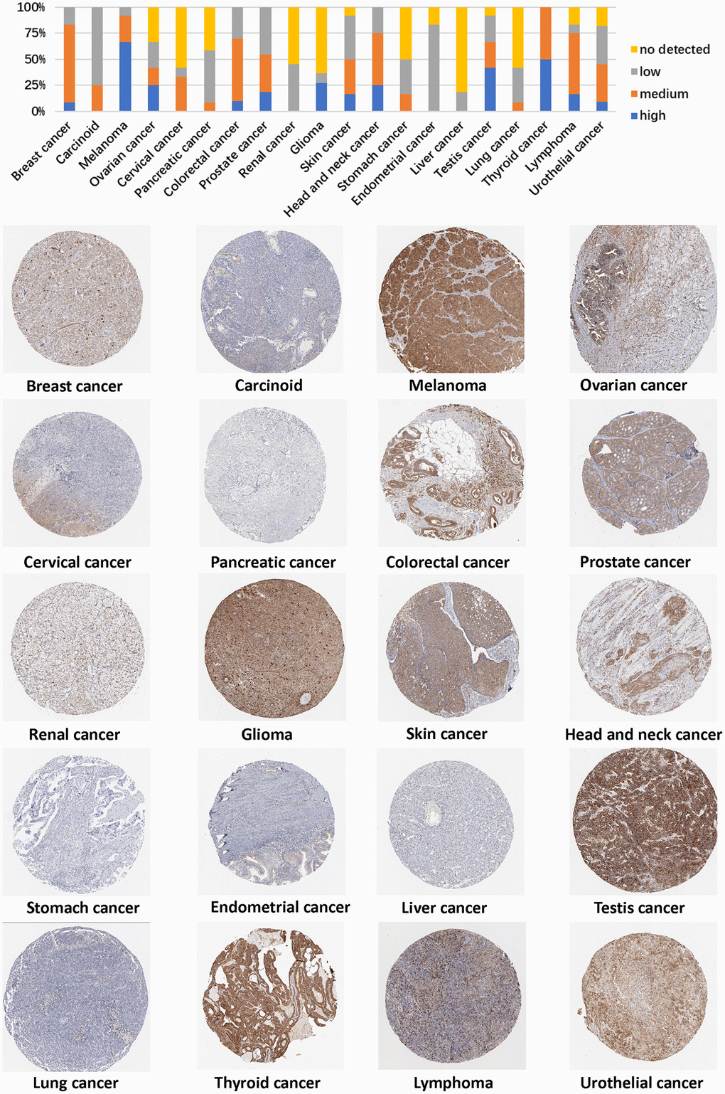 Representative immunohistochemical staining results of the PXN protein in different cancer tissues.