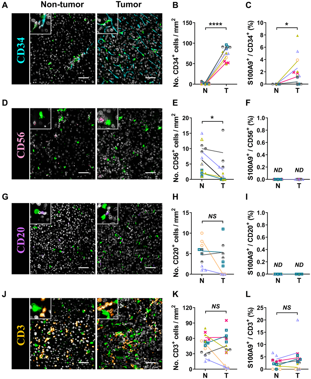 Characterization of patient-derived S100A9+ cells. Multiple immunofluorescence staining shows DAPI (gray), S100A9 (green), CD34 (blue, A), CD56 (pink, D), CD20 (purple, G), and CD3 (orange, J) expression and coexpression (double-positive cells) in HCC tissue. Quantification of CD34 (B), CD56 (E), CD20 (H), and CD3 (K) cell densities in the T and N regions. (C) The percentages of S100A9+CD34+ cells among the total CD34+ cells in the N and T regions. (F) The percentages of S100A9+CD56+ cells among the total CD56+ cells in the N and T regions. (I) The percentages of S100A9+CD20+ cells among the total CD20+ cells in the N and T regions. (L) The percentages of S100A9+CD3+ cells among total CD3+ cells in the N and T regions (n = 4 - 7). Scale bar = 50 μm. The results are the means ± SEM (bars); NS, no significance; ND, not detected.