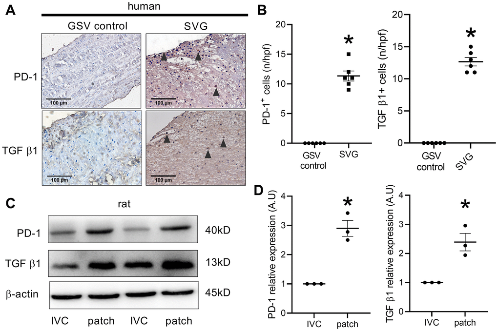 PD-1 expression in human and rat venous neointimas. (A) Immunohistochemistry images showing PD-1 and TGF β1 expression in the native human great saphenous vein (GSV control) and the neointima of spiral great saphenous vein graft (SVG); black arrowhead showing positive cells; scale bar, 100 μm; n = 3. (B) Bar graphs showing PD-1- (*p t-test) and TGF β1-positive cells (*p t-test) per high-power field in the human GSV and SVG neointima, n = 6. (C) Western blot showing the expression of PD-1, TGF β1, and β-actin in the rat IVC and the patch after patch venoplasty at day 14; n = 3. (D) Bar graph showing PD-1 (*p = 0.0022, t-test) and TGF β1 (*p = 0.0128, t-test) density; n = 3.