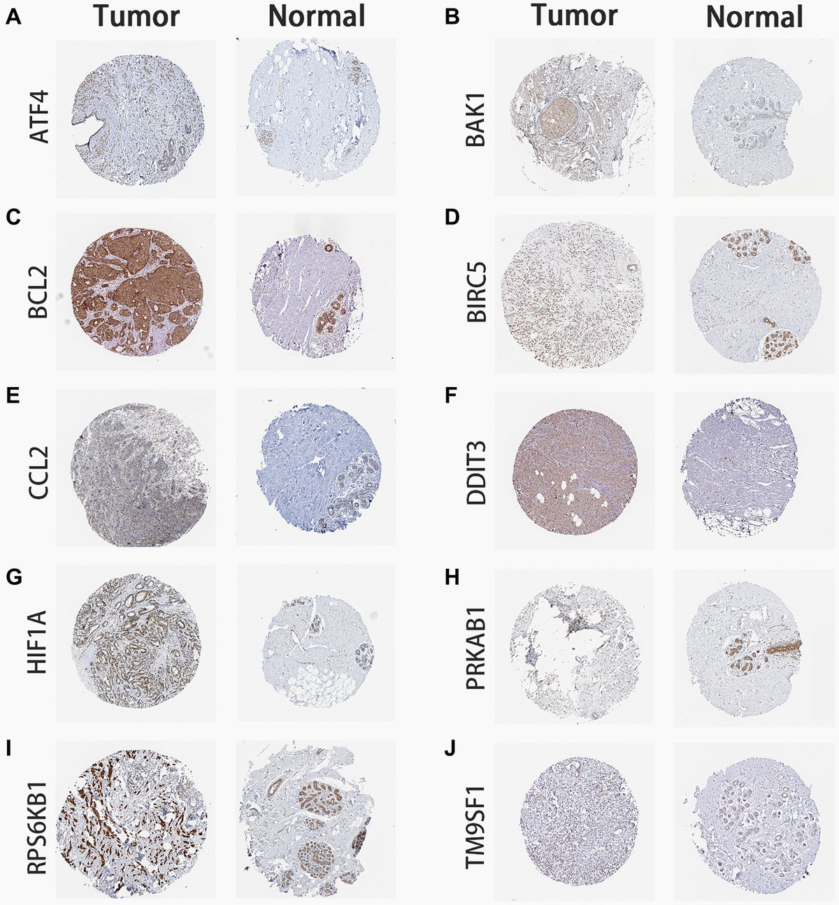 Immunohistochemistry of ARG expression. BC tumor and normal breast tissue images are shown for the signature’s ARG-coded proteins. (A) ATF4 expression. (B) BAK1 expression. (C) BCL2 expression. (D) BIRC5 expression. (E) CCL2 expression. (F) DDIT3 expression. (G) HIF1A expression. (H) PRKAB1 expression. (I) RPS6KB1 expression. (J) TM9SF1 expression. Images were obtained from the Human Protein Atlas database (<a href="https://www.proteinatlas.org/" target="