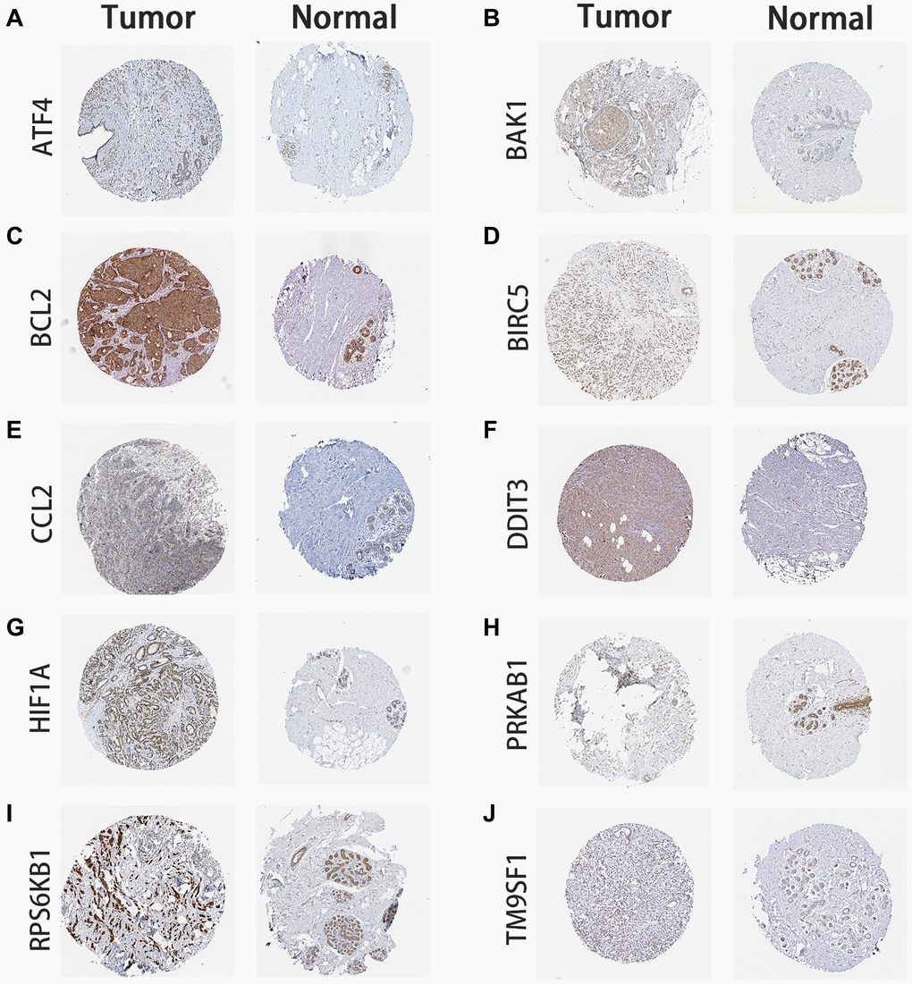 Immunohistochemistry of ARG expression. BC tumor and normal breast tissue images are shown for the signature’s ARG-coded proteins. (A) ATF4 expression. (B) BAK1 expression. (C) BCL2 expression. (D) BIRC5 expression. (E) CCL2 expression. (F) DDIT3 expression. (G) HIF1A expression. (H) PRKAB1 expression. (I) RPS6KB1 expression. (J) TM9SF1 expression. Images were obtained from the Human Protein Atlas database (https://www.proteinatlas.org/).