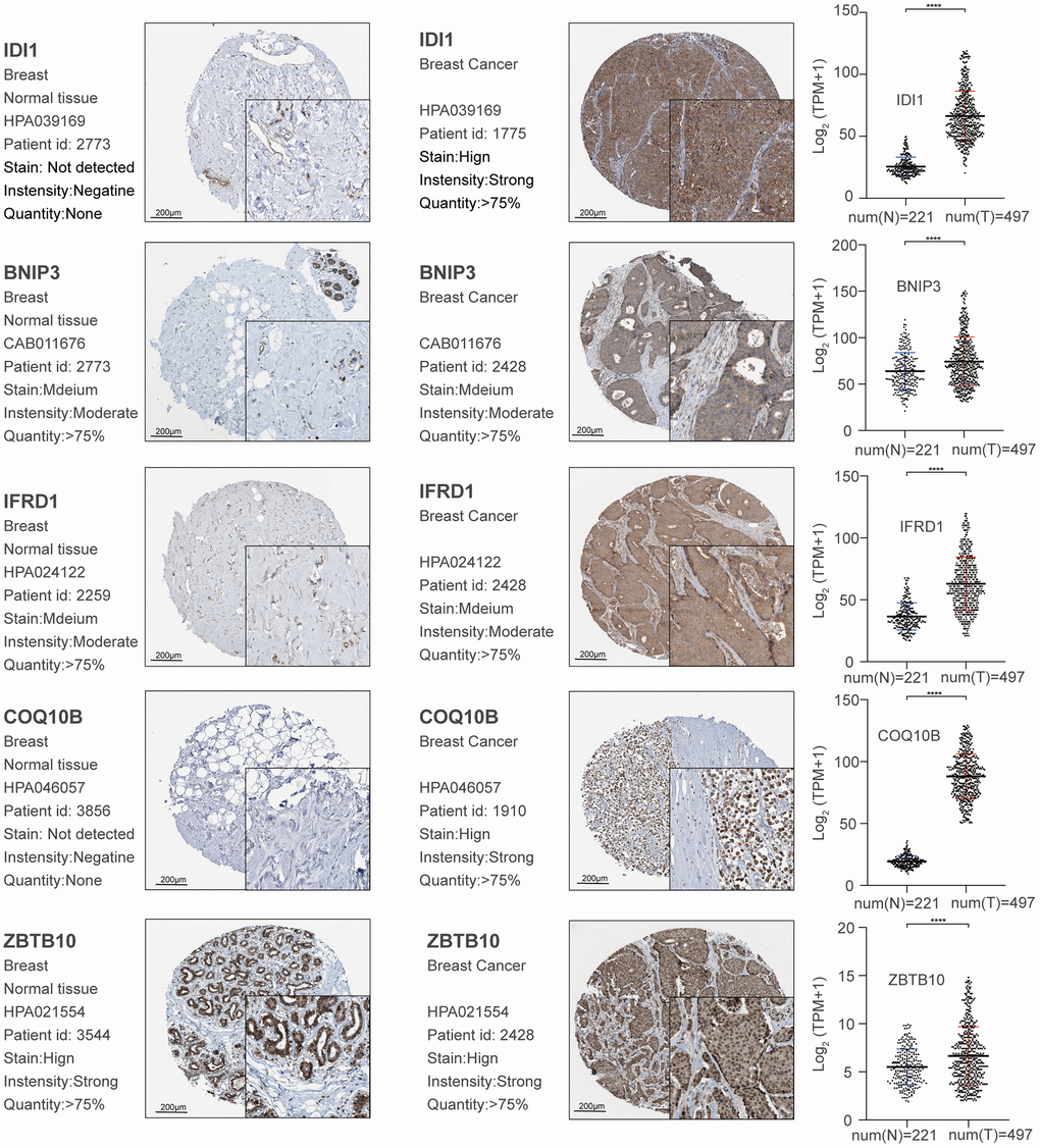 Validation of significant core genes in breast cancer bone metastasis via immunohistochemistry and RNA expression analysis.