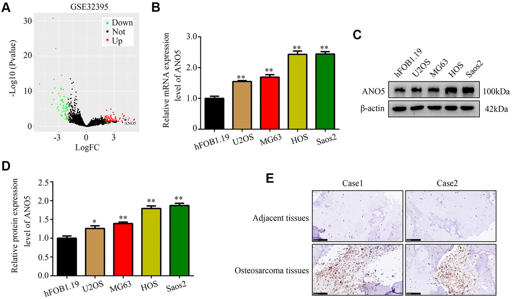 ANO5 was upregulated in osteosarcoma. (A) A volcano plot showed that the ANO5 gene was significantly upregulated in osteosarcoma cells. (B) qRT-PCR indicated that ANO5 was upregulated in osteosarcoma cells (U2OS, MG63, HOS, and Saos2) compared to the normal osteoblast cell line hFOB 1.19. (C, D) Western blot indicated that ANO5 was upregulated in osteosarcoma cells (U2OS, MG63, HOS, and Saos2) compared to the normal osteoblast cell line hFOB 1.19. (E) IHC demonstrated that ANO5 was more highly expressed in osteosarcoma tissues than in adjacent normal tissues. *, PP