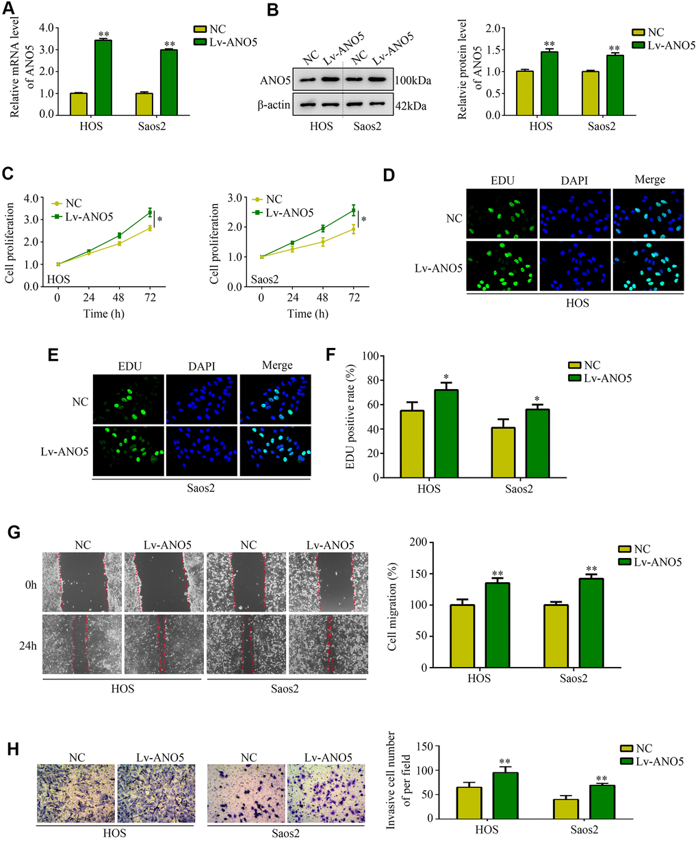 Overexpression of ANO5 increased osteosarcoma cell proliferation and metastasis in vitro. (A, B) qRT-PCR and western blot were used to evaluate the transfection efficiency of ANO5 overexpression lentivirus. (C) A CCK-8 assay was used to examine the effects of ANO5 overexpression on osteosarcoma cell proliferation. (D–F) EDU assays showed that proliferation rates were higher in ANO5 overexpression osteosarcoma cells. (G) A wound healing assay was used to determine the effect of ANO5 overexpression on osteosarcoma cell migration. (H) A transwell assay was used to determine the effect of ANO5 overexpression on osteosarcoma cell invasion. *, PP