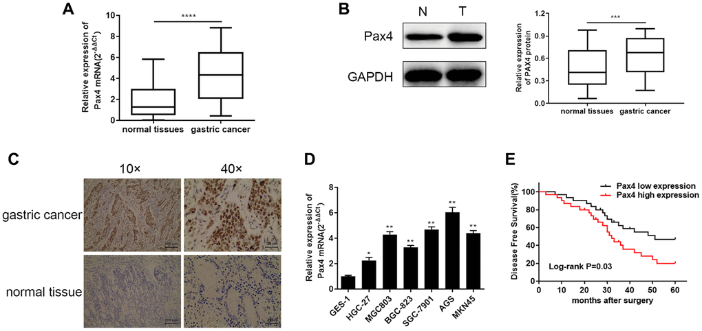 Elevated PAX4 mRNA and protein expression in both GC tissues and cell lines. (A, B) Higher PAX4 mRNA and protein expression in GC tissues compared to normal tissues (n = 60) by qRT-PCR (P P = 0.0002). (C) The IHC results between GC and non-GC tissues demonstrated excessive PAX4 in GC tissues. (D) Overexpression of PAX4 mRNA levels were identified across six GC cell lines (HGC-27, MGC803, BGC-823, SGC-7901, AGS, MKN45) compared to the human gastric mucosal epithelial cell line GES-1. (E) The overall survival analysis results demonstrated that PAX4 high expression in GC is associated with poor prognosis.