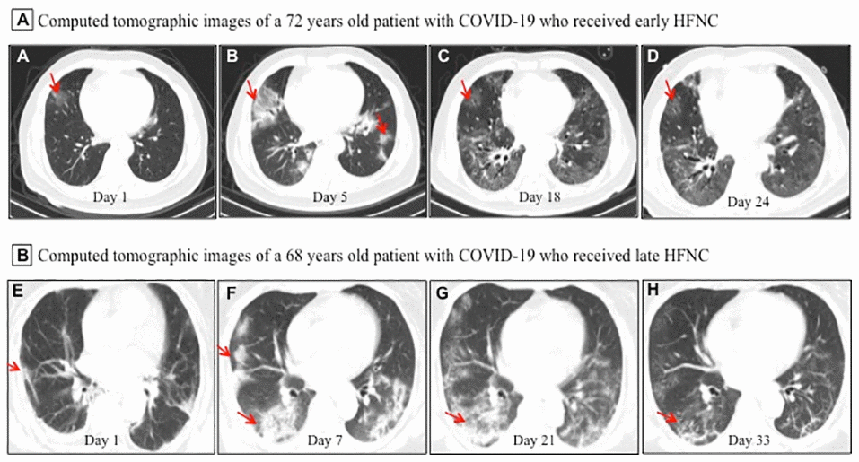 Representative chest computed tomographic images of elderly patients with COVID-19 who received early or late high-flow nasal cannula (HFNC). (A–D) A 72 year old man with COVID-19 received early HFNC therapy when his PaO2/FiO2 was 256 mmHg. (A) Image obtained on day 1 showed small ground-glass opacity lesion (red arrow) in the middle lobe of the right lung; (B) image obtained on day 5 showed enlarged lesion in right lung and several small areas of new exudative lesions in outer basal segment of lower lobe of left lung; (C) image obtained on day 18 showed the lesion in the middle lobe of the right lung reduced more than 50%, and clear interstitial lesions were found in the lower lobes of both lungs; (D) image obtained day 24 showed the lesions were further reduced and became lighter in density (red arrow). HFNC was discontinued on day 23, and this patient was discharged on Day 26. (E, F) A 68 year old man with COVID-19 received late HFNC oxygen therapy when his PaO2/FiO2 was 186 mmHg. (E) Image obtained on day 1 showed a few patchy exudative lesions and cord like fibrosis in bilateral lobes of both lungs (red arrow); (F) image obtained on day 7 showed original lesions were obviously increased, and parenchymal lesions (such as consolidation and air bronchogram) in the middle and lower lobes of right lung, as well as appearance of interstitial lesions in lower left lung; (G) image obtained on day 21 showed increased patchy exudative lesions and interstitial lesions with light density (a few reticular lung changes) in lower left lung; (H) image obtained on day 33 showed a few grid lung changes and subpleural lines in the right lower lobe. This patient required invasive mechanical ventilation on day 23, and died of cardiac arrest on day 36 after admission.