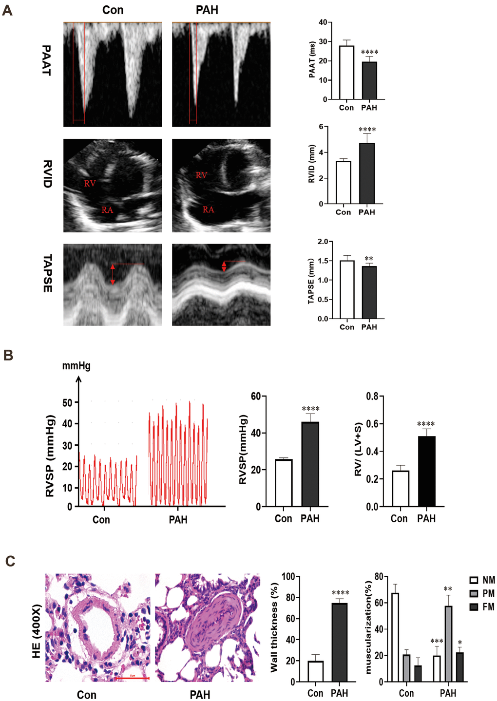 (A) Changes of echocardiography in rats after intraperitoneal injection of monocrotaline (MCT) for 4 weeks. (B) The hemodynamic test results of the two groups. Compared with the control group, the right ventricular systolic pressure was significantly increased in the PAH group, and RV/ (LV + S) also increased in the PAH group. (C) Pulmonary artery HE staining images of the control group and PAH group were obtained under microscopy. Pulmonary artery remodeling was observed in PAH group compared with control group. *P P P P 