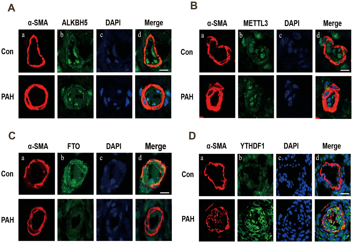 Immunofluorescence was used to detect the expression of ALKBH5 (A), METTL3 (B), FTO (C) and YTHDF1 (D) in pulmonary vessels. (A) Vascular staining image (red), (B) objective protein staining image (green), (C) nuclei staining image (blue), (D) merged images.