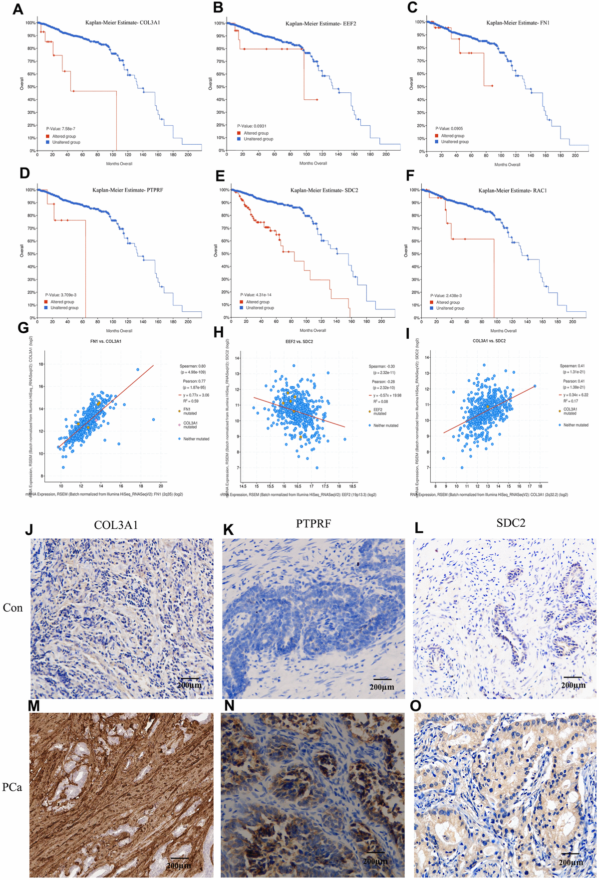 Kaplan-Meier estimation of the overall survival and identification of the key molecules by immunohistochemistry in patients samples. Overall survival analysis of COL3A1 (A), EEF2 (B), FN1 (C), PTPRF (D), SDC2 (E), and RAC1 (F). Expression linear correlations between FN1 vs. COL3A1 (G), EEF2 vs. SDC2 (H), and COL3A1 vs. SDC2 (I). (J–O) Detection of COL3A1, PTPRF, and SDC2 expression by immunohistochemistry in representative BM PCa and controls.