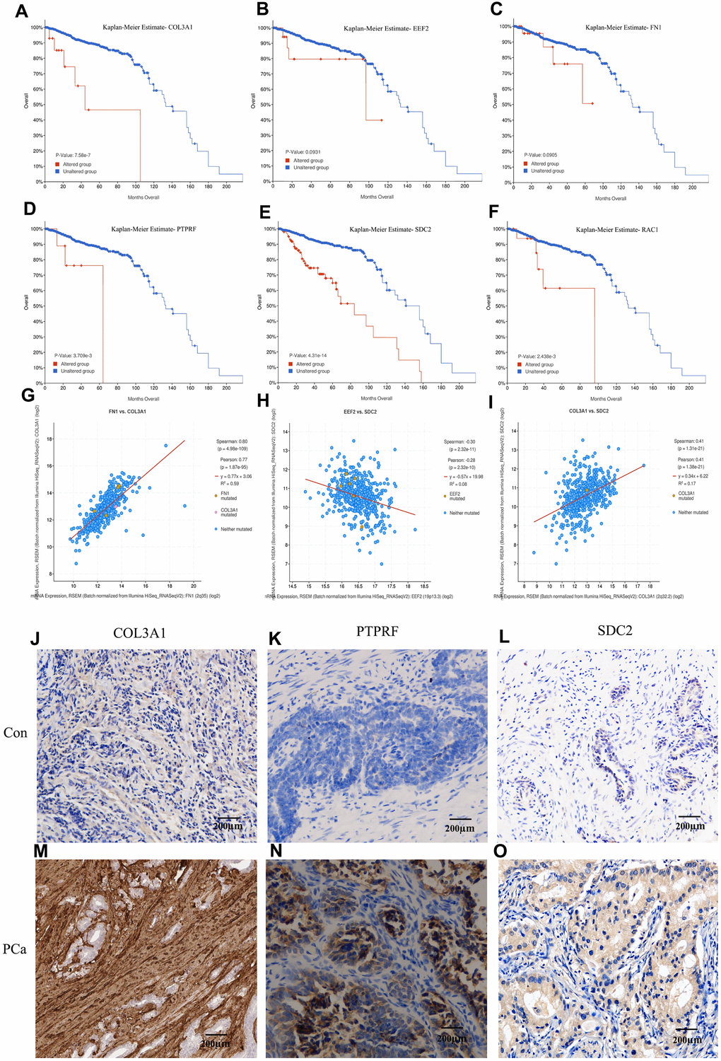 Kaplan-Meier estimation of the overall survival and identification of the key molecules by immunohistochemistry in patients samples. Overall survival analysis of COL3A1 (A), EEF2 (B), FN1 (C), PTPRF (D), SDC2 (E), and RAC1 (F). Expression linear correlations between FN1 vs. COL3A1 (G), EEF2 vs. SDC2 (H), and COL3A1 vs. SDC2 (I). (J–O) Detection of COL3A1, PTPRF, and SDC2 expression by immunohistochemistry in representative BM PCa and controls.